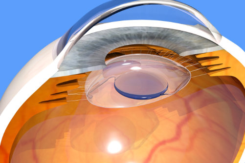 Cataract surgery cross section
