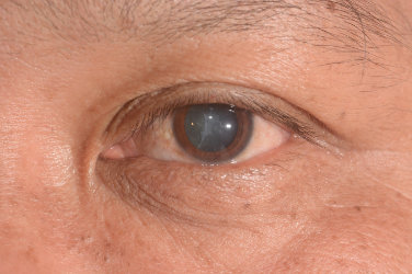 Cataract close-up